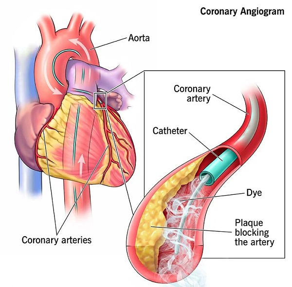 روش های آنژیوگرافی قلب چگونه است