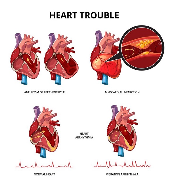 افزایش ضخامت عضله قلب چیست