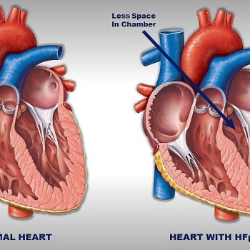 افزایش ضخامت عضله قلب چه علائمی دارد