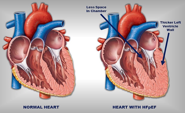 افزایش ضخامت عضله قلب چه علائمی دارد