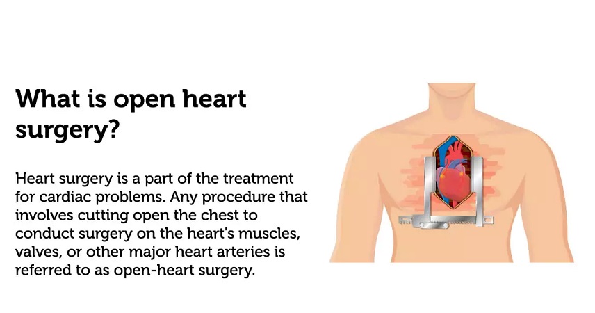 جراحی عمل باز قلب